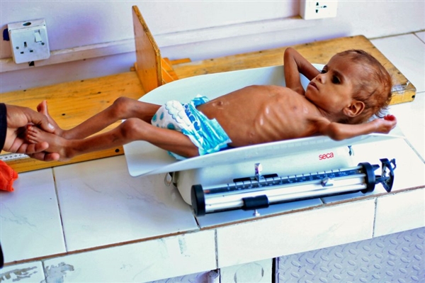 الأمم المتحدة: اليمن قد يشهد "أسوأ مجاعة في العالم منذ 100 عام"