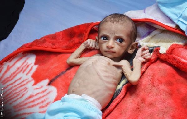 85 ألف طفل.. حصاد سوء التغذية في اليمن خلال 3 سنوات