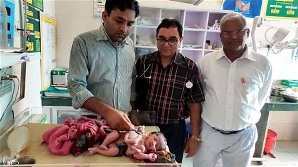 صدمة طبية .. ولادة طفلة بأربع أرجل و3 أياد