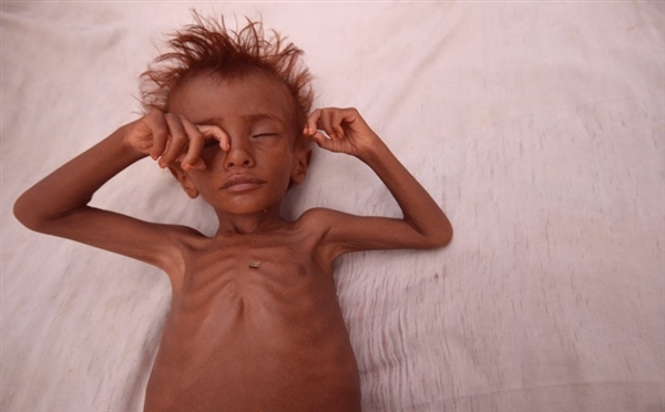 وفاة طفل تحت سن الخامسة كل 12 دقيقة باليمن (مسؤول أممي)