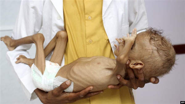 Yeme'de 7 milyon 400 bin çocuk yetersiz besleniyor