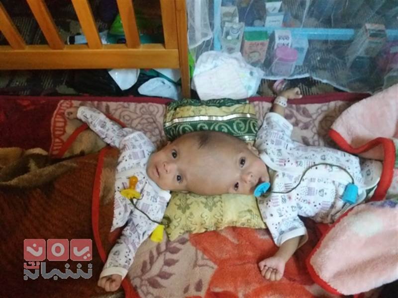 Yemenli yapışık siyam ikizler ayrılmak için yardım bekliyor