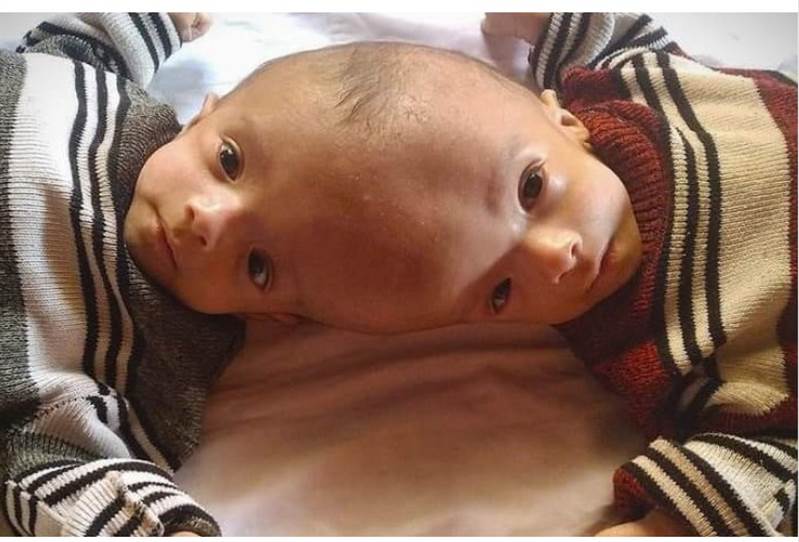 Yemen’de yapışık siyam ikizleri ayrılmak için yardım bekliyor