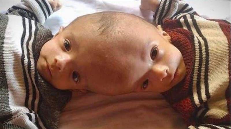 Yemenli yapışık siyam ikizleri Suudi Arabistan’da yarın yapılacak operasyonla ayrılacak