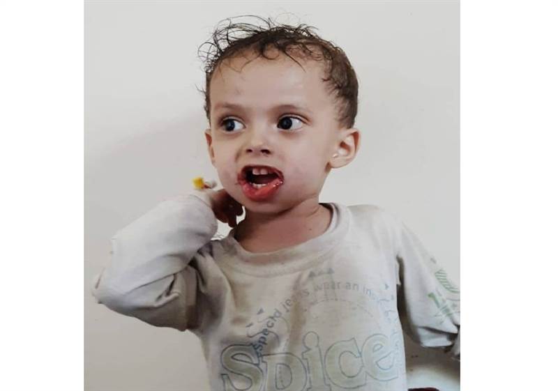 توفي بعد 4 ساعات من دخوله المستشفى.. وفاة طفل متأثرا بإصابته بداء الكلب وسط صنعاء