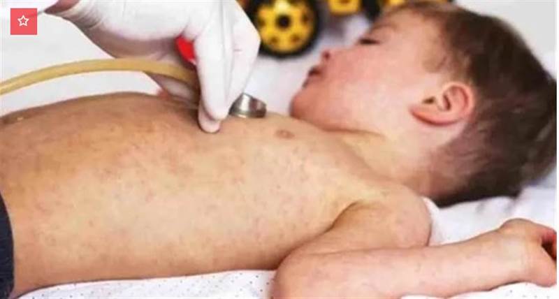 BM: Yemen’de 2023 yılı başından itibaren 77 çocuk kızamık sebebiyle öldü