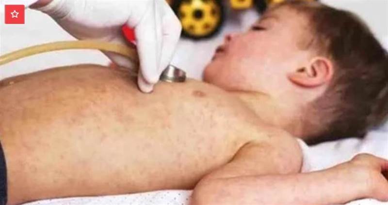 BM raporu: Bu yılın başından bu yana İbb'de yaklaşık 1.600 vaka ve 16 kızamıktan ölüm kaydedildi