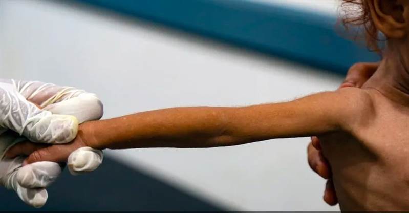 BM: Yemen’de kızamığa 50 bin kişi yakalandı 568 kişi öldü