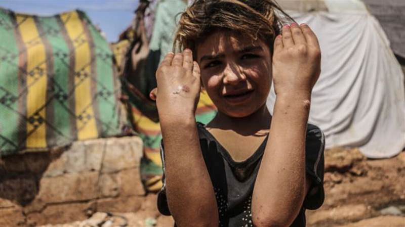 اصابت نحو 15 ألف شخص في مناطق المليشيات.. ماهي جائحة "الليشمانيا"
