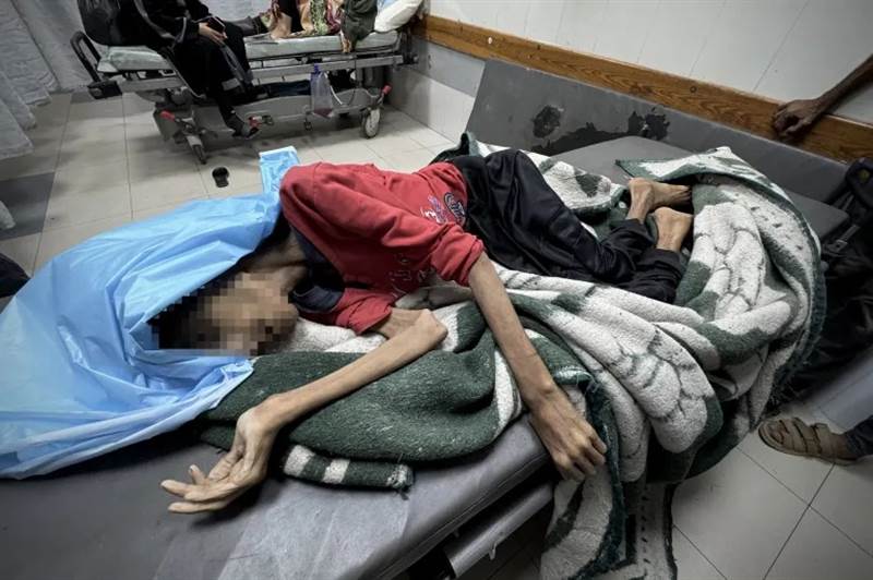 çlıktan 25 Kiloya Düşen Filistinli Kadın Gazze’de Hayatını Kaybetti